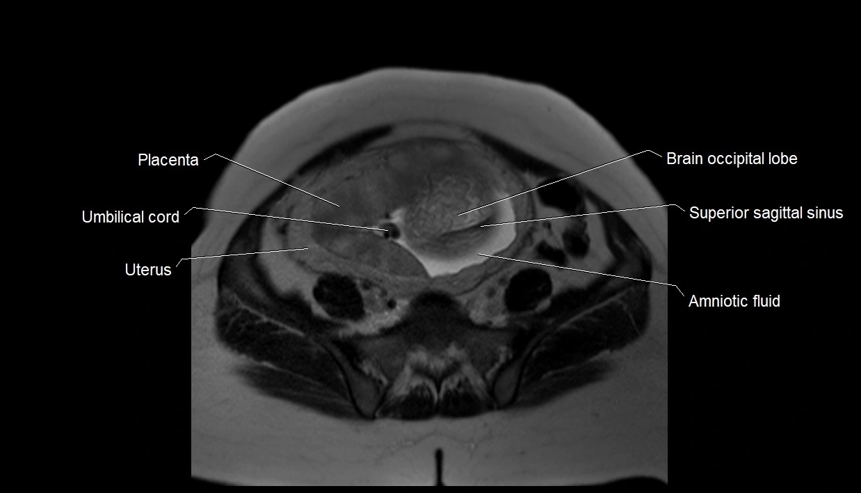 MRI fetal anatomy axial image 27.webp
